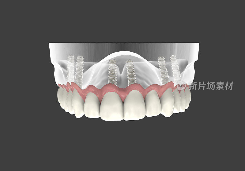 3 d渲染implantat